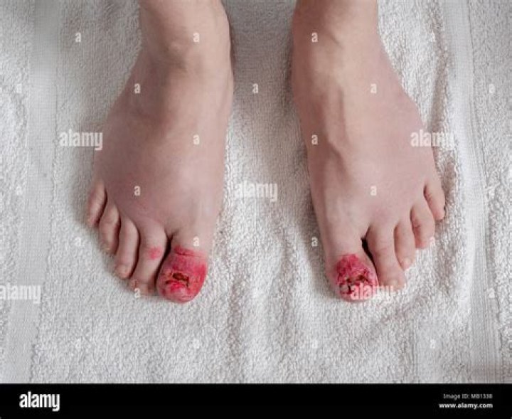 Can you shower after toenail removal?