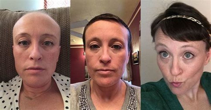 Does everyone lose their hair on chemo?