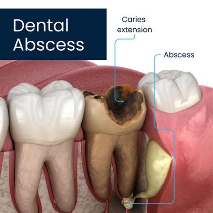 How do you stop abscess pain?