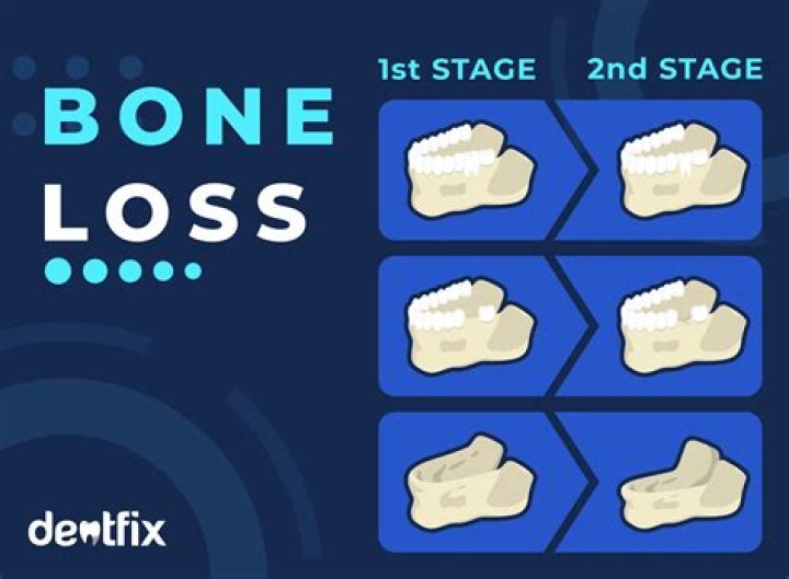 How fast is bone loss with dentures?