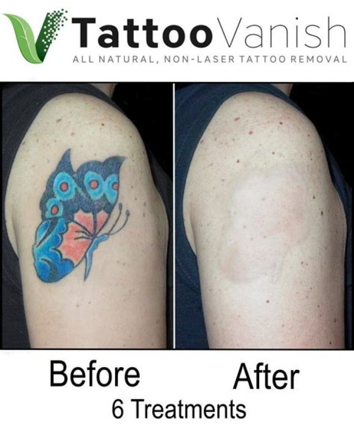 How soon can you remove a tattoo?