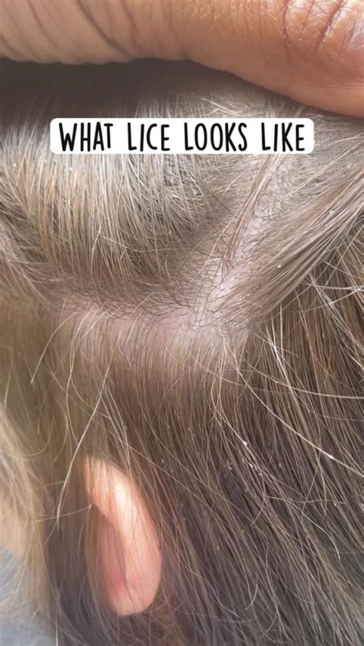 What can lice do to you?