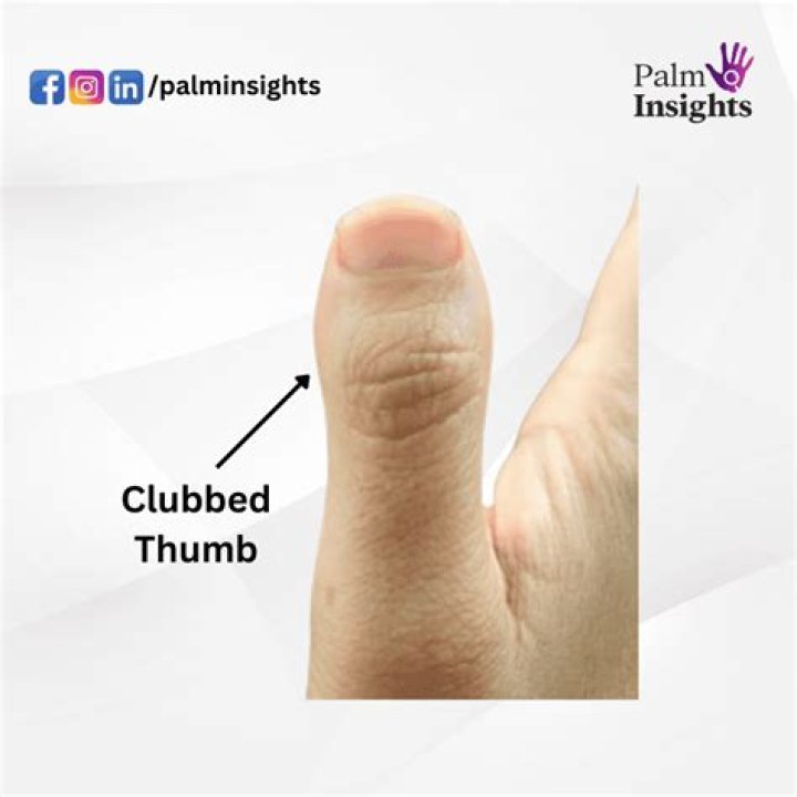 What do long thumbs indicate?