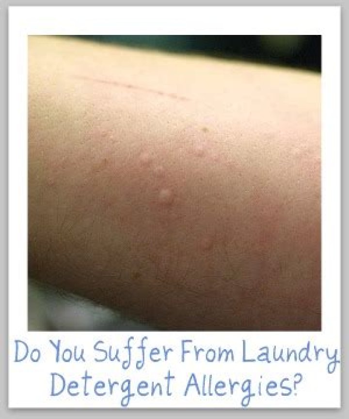 What does an allergic reaction to laundry soap look like?