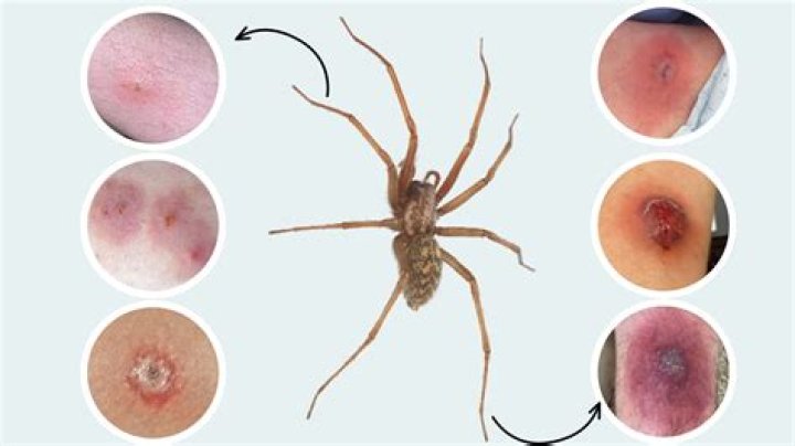 What does your skin look like when you get bit by a brown recluse?