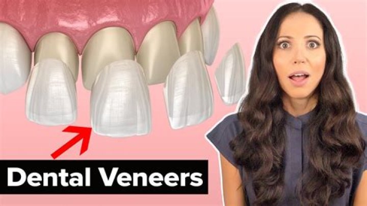 What happens if you dont change veneers?
