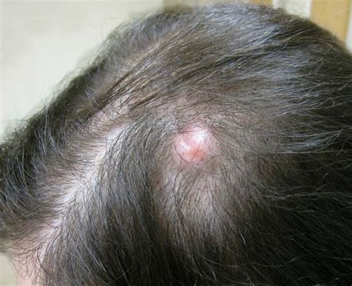 What is a pilar cyst?