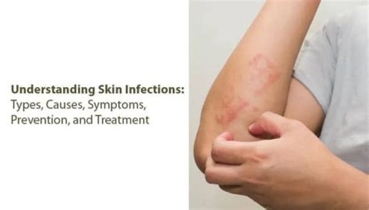 Will skin infections clear without antibiotics?